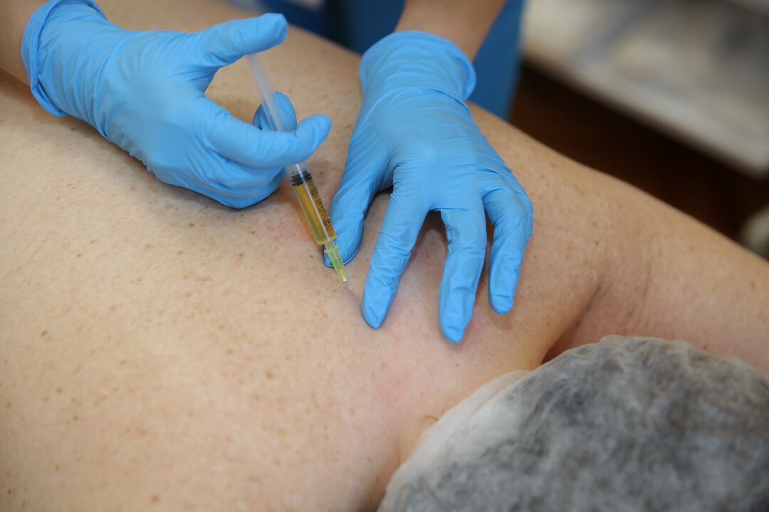 zastrzyki chondroprotektorów na plecy